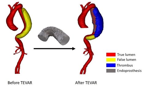 Figure 1: Type B aortic dissection before and after implanting an endoprosthesis, during TEVAR. After the treatment, partial thrombus formation of the false lumen was observed.