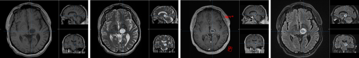 figure 1: magnetic resonance imaging of a brain tumour with different sequences  (T1-weighted, T2-weighted, MPRAGE, FLAIR)