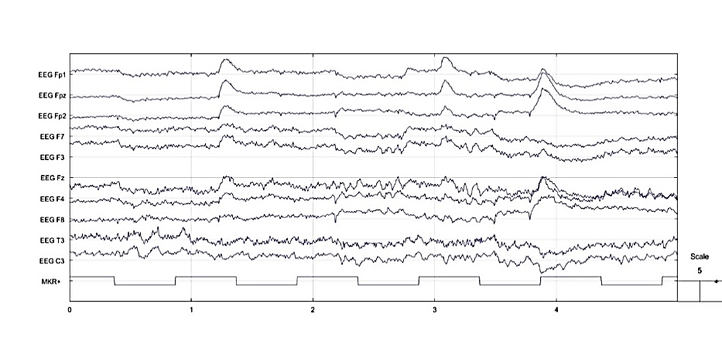 Figure 1 c) EEG waves collected by hook fabric textrodes
