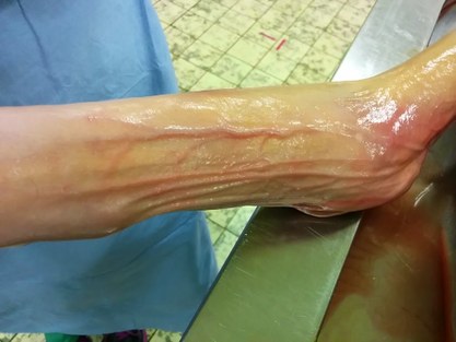 Reperfused arm veins