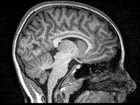 A picture of a T1-weighted MRI scan of the head.